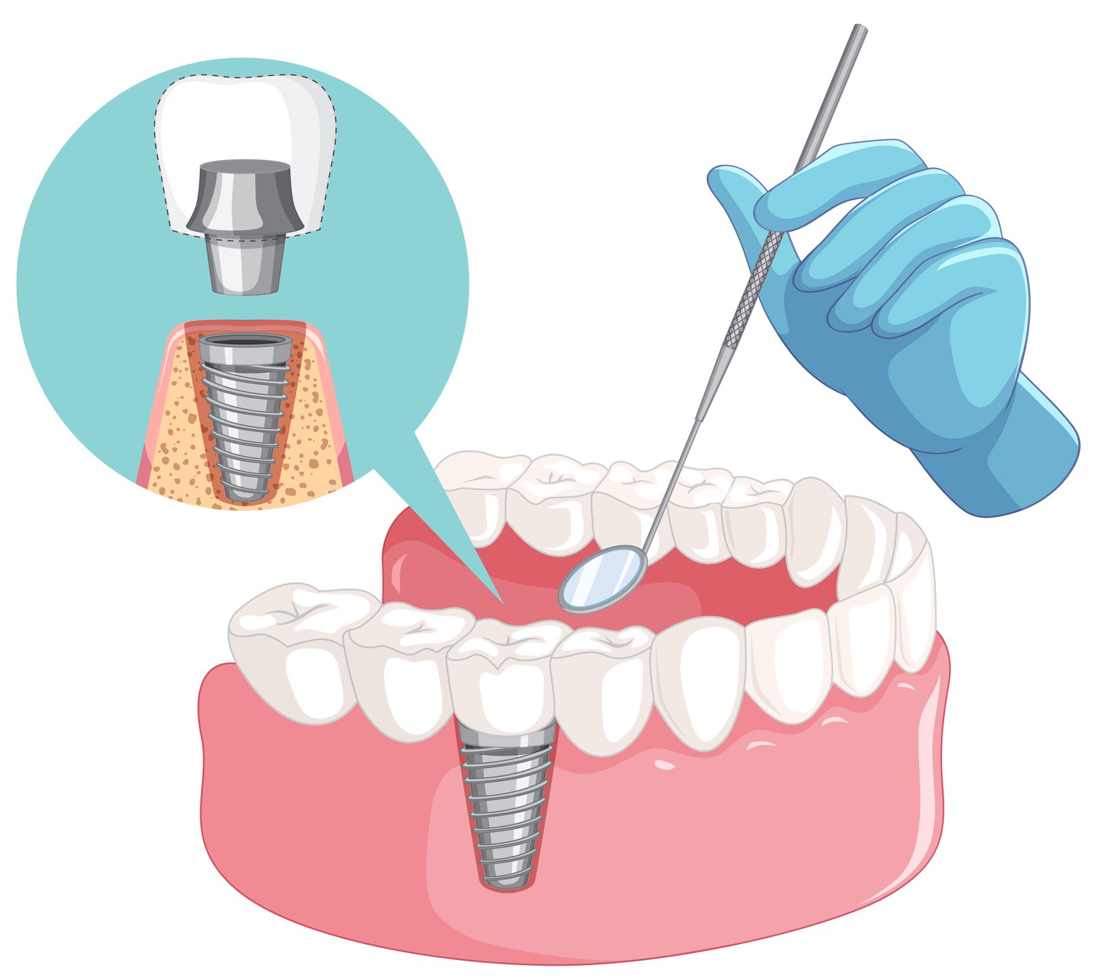 Dental Implant